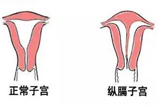 纵膈子宫做试管可以吗？具体方案是什么？